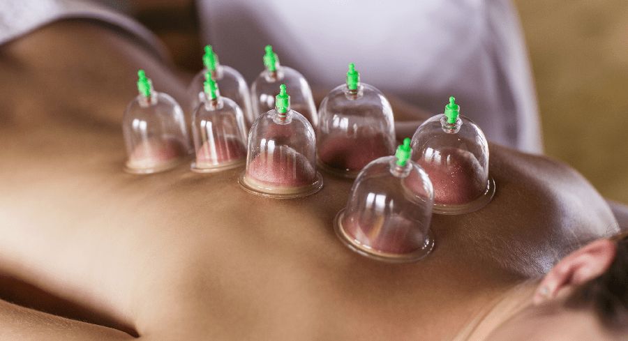Aplicação de ventosas terapêuticas